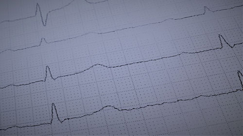 EKG1 EKG1